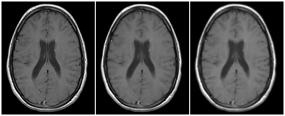 Filtering examples with the T1w MRI stack available in Fiji examples images.