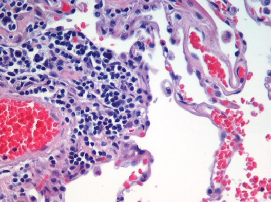 Emphysema h and e